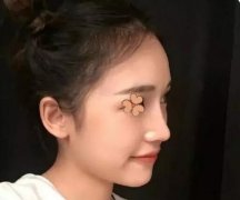 深圳福华整形医院做的超体隆鼻果图，本人很喜欢！