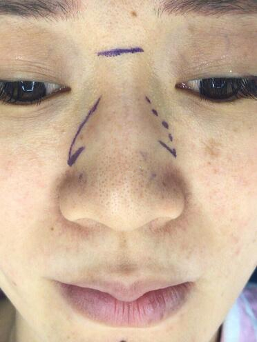 深圳福华整形医院做的超体隆鼻，本人很喜欢
