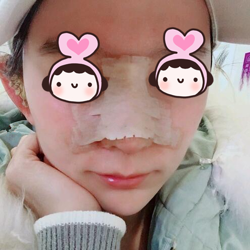 自从在萍乡丽芙整形医院做了隆鼻手术后，我也是侧颜女神了