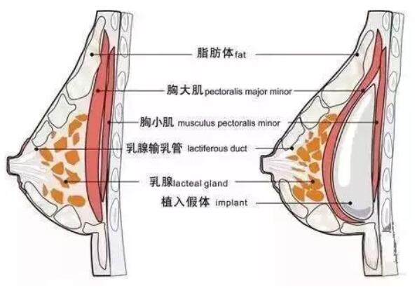 水滴形假体和圆形假体各自的优缺点、性价比，更容易选择了…