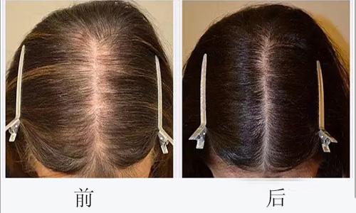 头发种植还有这一些副作用！绝大部分医生不可能对你说