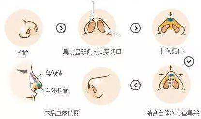 隆鼻手术如何做？详尽步骤讲解一下下