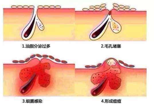 激光调节痤疮过后会再发作吗？担忧脸上痘痘反反复复