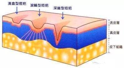 激光调节痤疮过后会再发作吗？担忧脸上痘痘反反复复