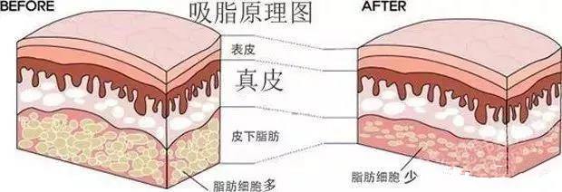 大腿吸脂手术需要多久？全部手术调节流程方法步骤
