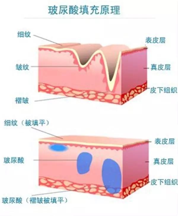 给你们瞧瞧玻尿酸注射的不良反应，看完你还敢反复注射？
