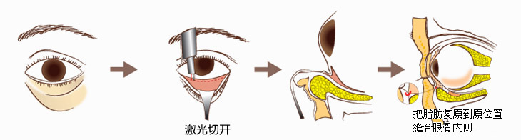 激光技术去眼袋价格？别让你的眼袋问题越变越大