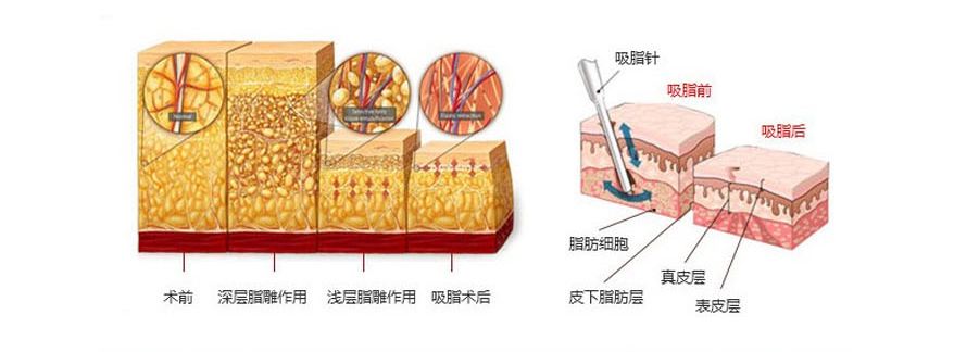 腰部吸脂减肥价钱明细表，附吸脂图