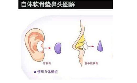 自体耳软骨垫鼻尖价钱、后遗症、整体