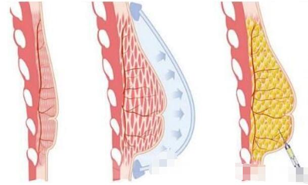 注射隆胸的优势：这就是有些人胸大的秘密