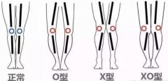 成年人的O型腿怎么矫正？学会这几种姿势无需动手术！