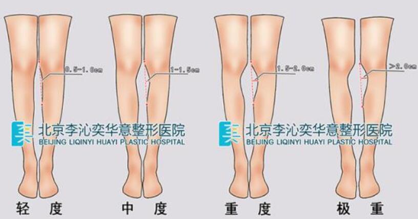 成年人的O型腿怎么矫正？学会这几种姿势无需动手术！