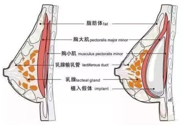 隆胸假体的放置位置