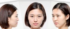 崔慧妍在韩国BK整形医院做的面部轮廓改造，了自己的麻豆梦