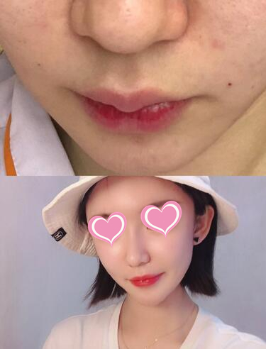 韩国医生主刀鼻尖整形修复术，术后她终于变得自信了！