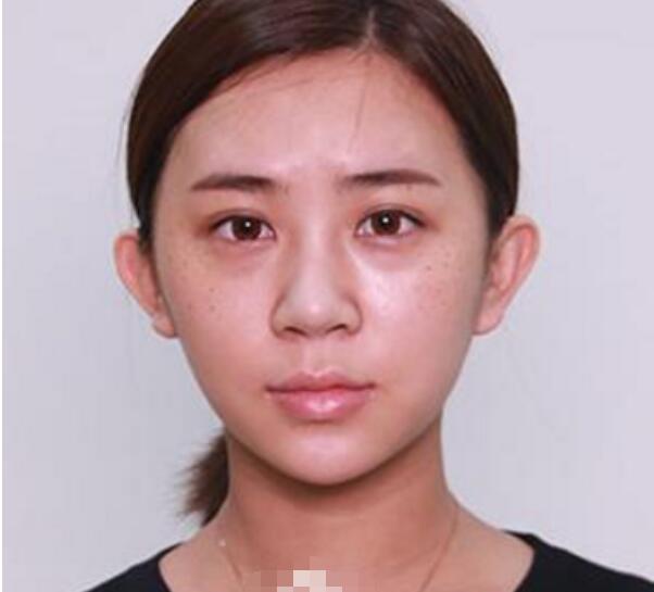 谈谈在深圳鹏程美容医院做的鼻整形，李子鹏医生的技术还不错！