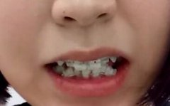 [案例]南宁牙齿矫正哪家好？术后果是19年给她较美好的回馈