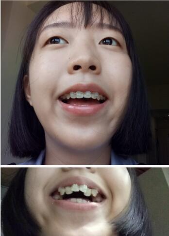 [介绍]南宁牙齿矫正哪家好？术后果是19年给她较美好的回馈