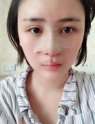 杭州薇琳隆鼻整形手术案例图，美腻的鼻子速成记