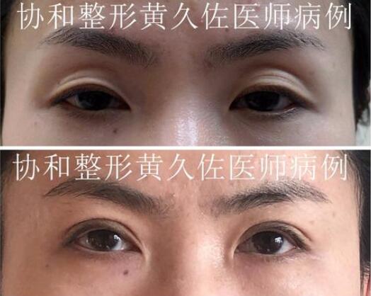 北京协和医院整形外科黄久佐医生双眼皮整形案例图