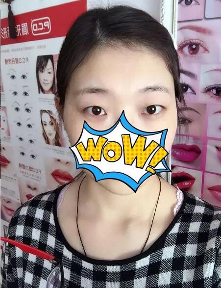 上海九院美容科双眼皮介绍，刘菲医生眼部介绍！