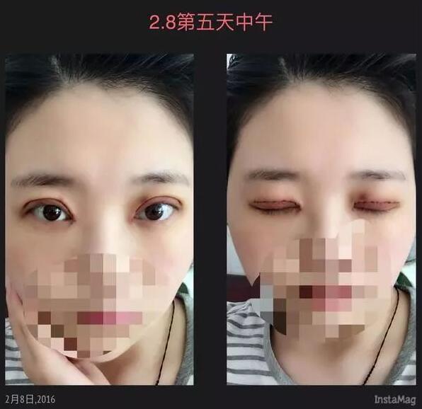 上海九院美容科双眼皮介绍，刘菲医生眼部介绍！