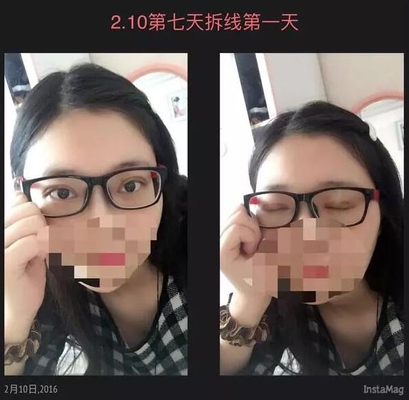 上海九院美容科双眼皮介绍，刘菲医生眼部介绍！