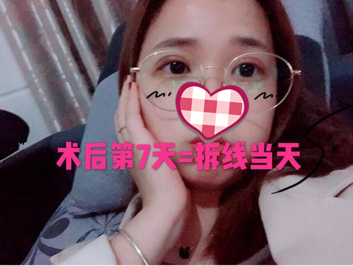 西京医院刘恒鑫医生做的双眼皮术后恢复图