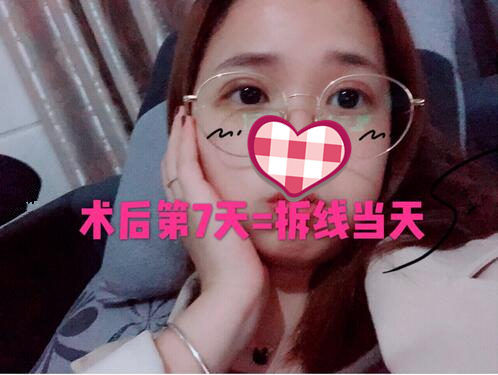 西京医院刘恒鑫双眼皮手术怎么样？介绍反馈来瞧瞧