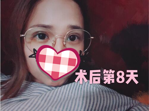 西京医院刘恒鑫双眼皮手术怎么样？介绍反馈来瞧瞧
