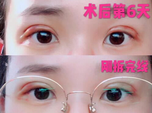 西京医院刘恒鑫双眼皮手术怎么样？介绍反馈来瞧瞧