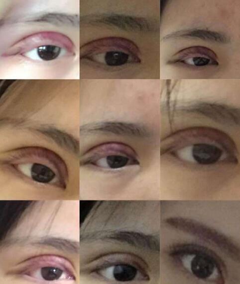北京协和医院整形科双眼皮案例图