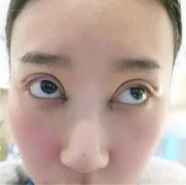 许再荣双眼皮介绍和价格反馈，爱美的你来康康~