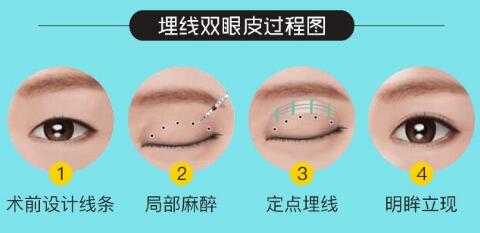 埋线双眼皮手术调节的整体及全过程分析图