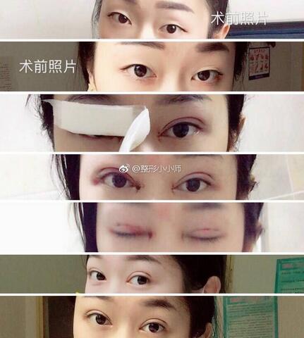 广州南方医院整形美容外科双眼皮案例
