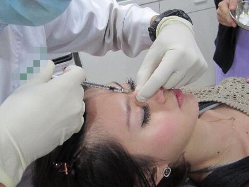 北京汇恩整形美容医院玻尿酸注射隆鼻案例