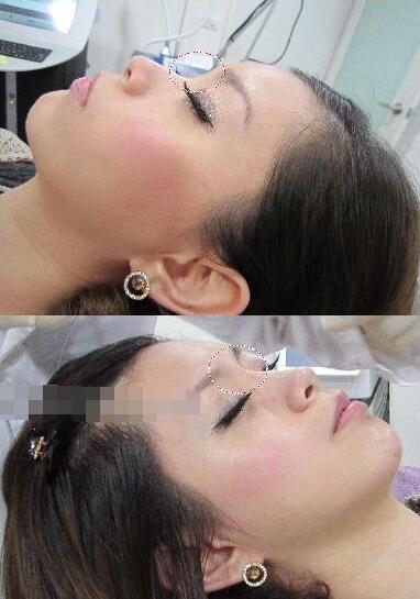 北京注射隆鼻经历：北京汇恩整形美容医院玻尿酸隆鼻介绍