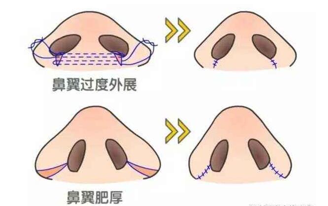 鼻翼收缩手术的操作步骤及术后护理事项