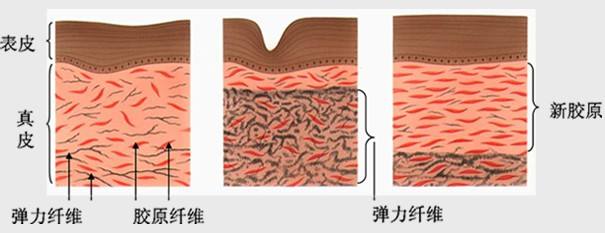 大象腿快看！激光溶脂瘦腿术咱们一起来了解一下