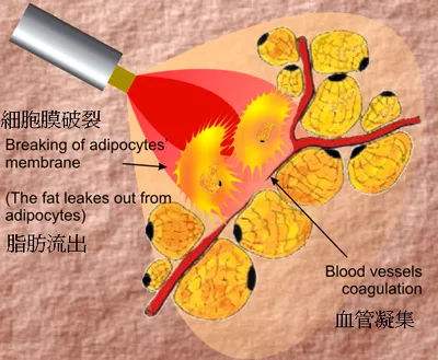 大象腿快看！激光溶脂瘦腿术咱们一起来了解一下