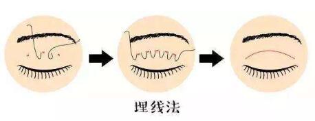 近期有人问埋线法双眼皮价格，带你了解一下！