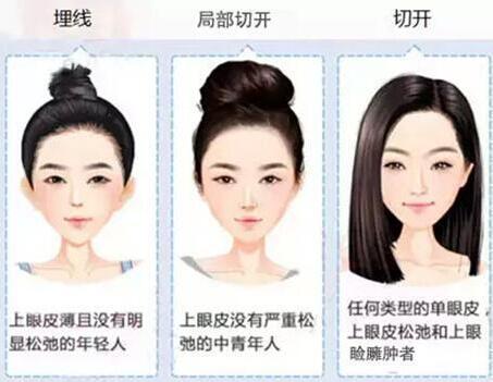 近期有人问埋线法双眼皮价格，带你了解一下！