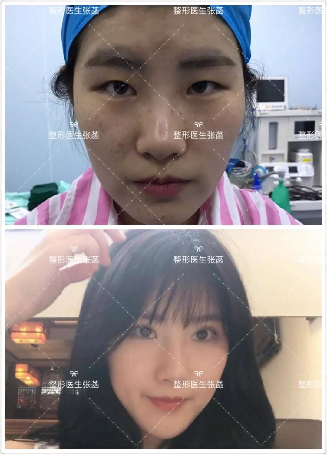 韩式三点双眼皮+无痕开眼角一个月了，分享前后对比效果图片~_珍美网