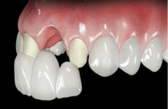 牙齿修复常用的几种方法，涨知识！