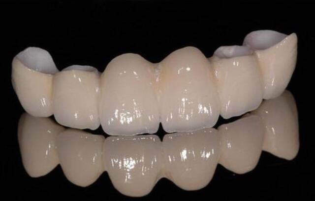 全瓷修复，与口腔组织融合，可以避免一些口腔疾病的影响