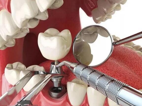 有的缺牙，没有残根就可以选择种植牙，它是属于一种医学牙科技术