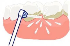洁牙洗牙对牙齿好吗？过程难受吗？