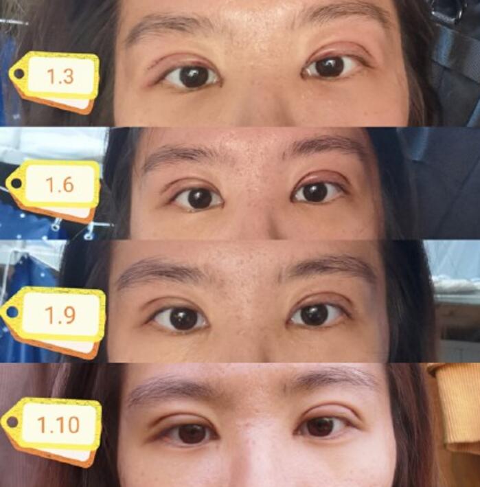 北京协和医院整形外科双眼皮案例图