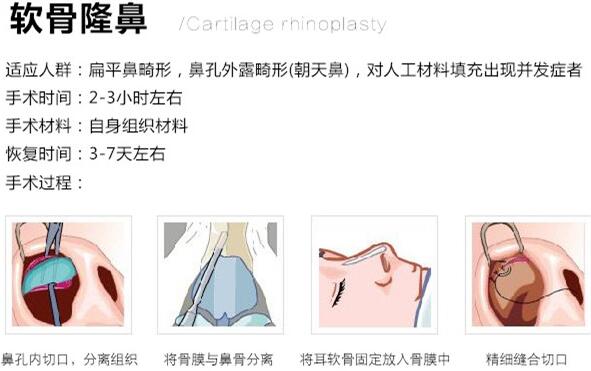 自体软骨隆鼻价格参差不齐，带你了解原因！