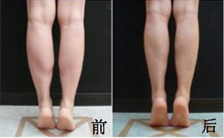 注射瘦脸瘦小腿可以瘦几厘米？要注射多少单位？